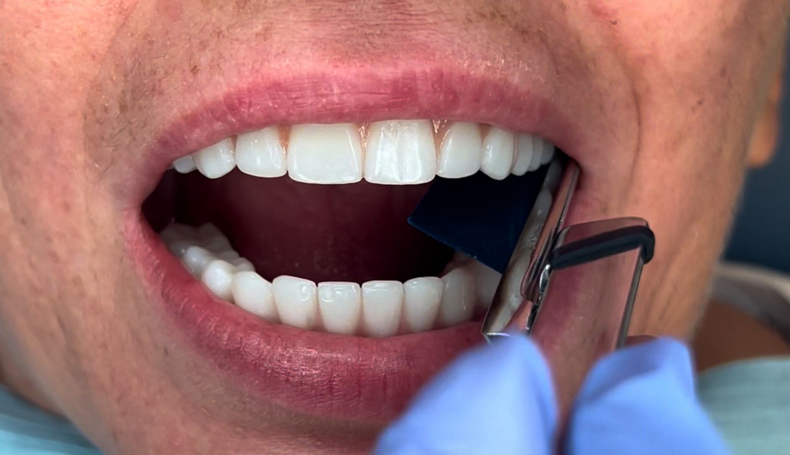 Odzyskaj Piękny Uśmiech z Natural Smile Journey™ w Luboniu 10 endoestetica badanie 2