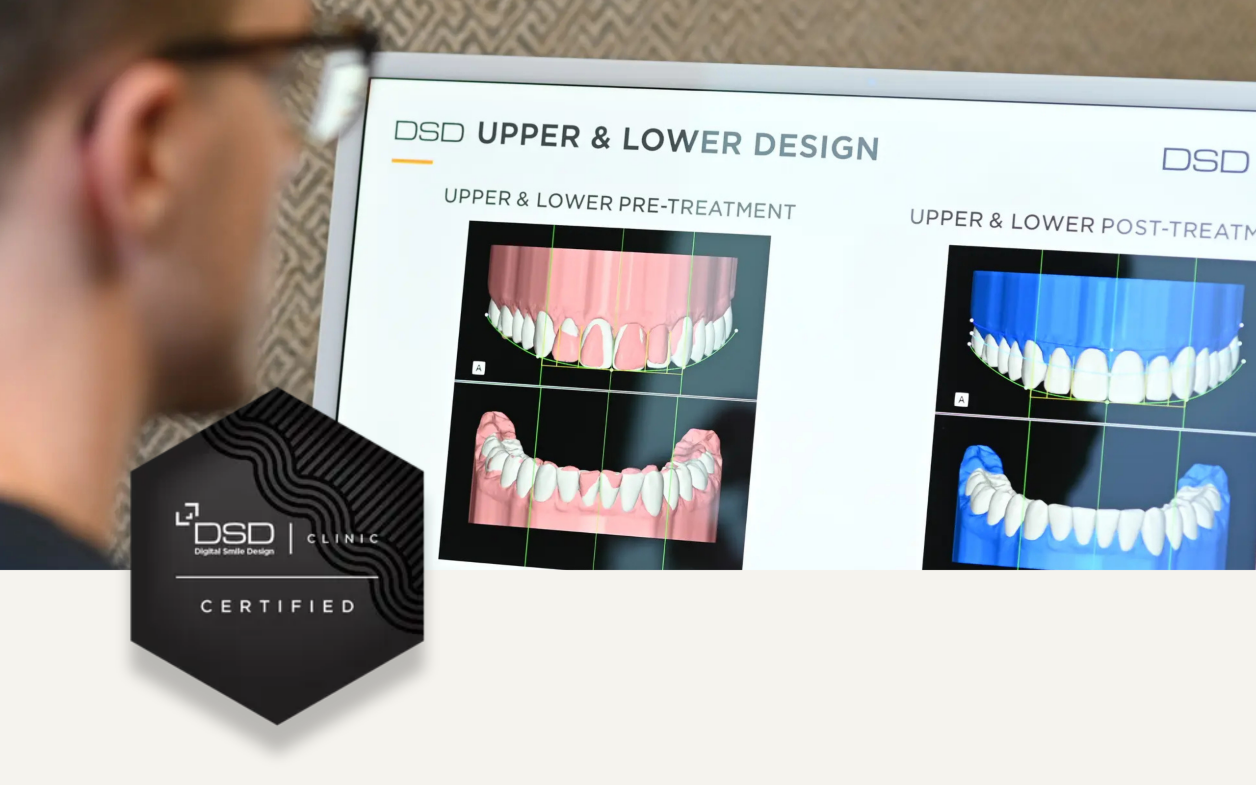 Licówki DSD w Luboniu – naturalny i piękny uśmiech na nowo 6 endoestetica baner naturalny usmiech dsd certified scaled