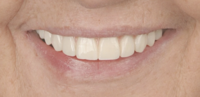 Jak zacząć leczenie stomatologiczne w EndoEstetica Luboń? 6 Po implantach