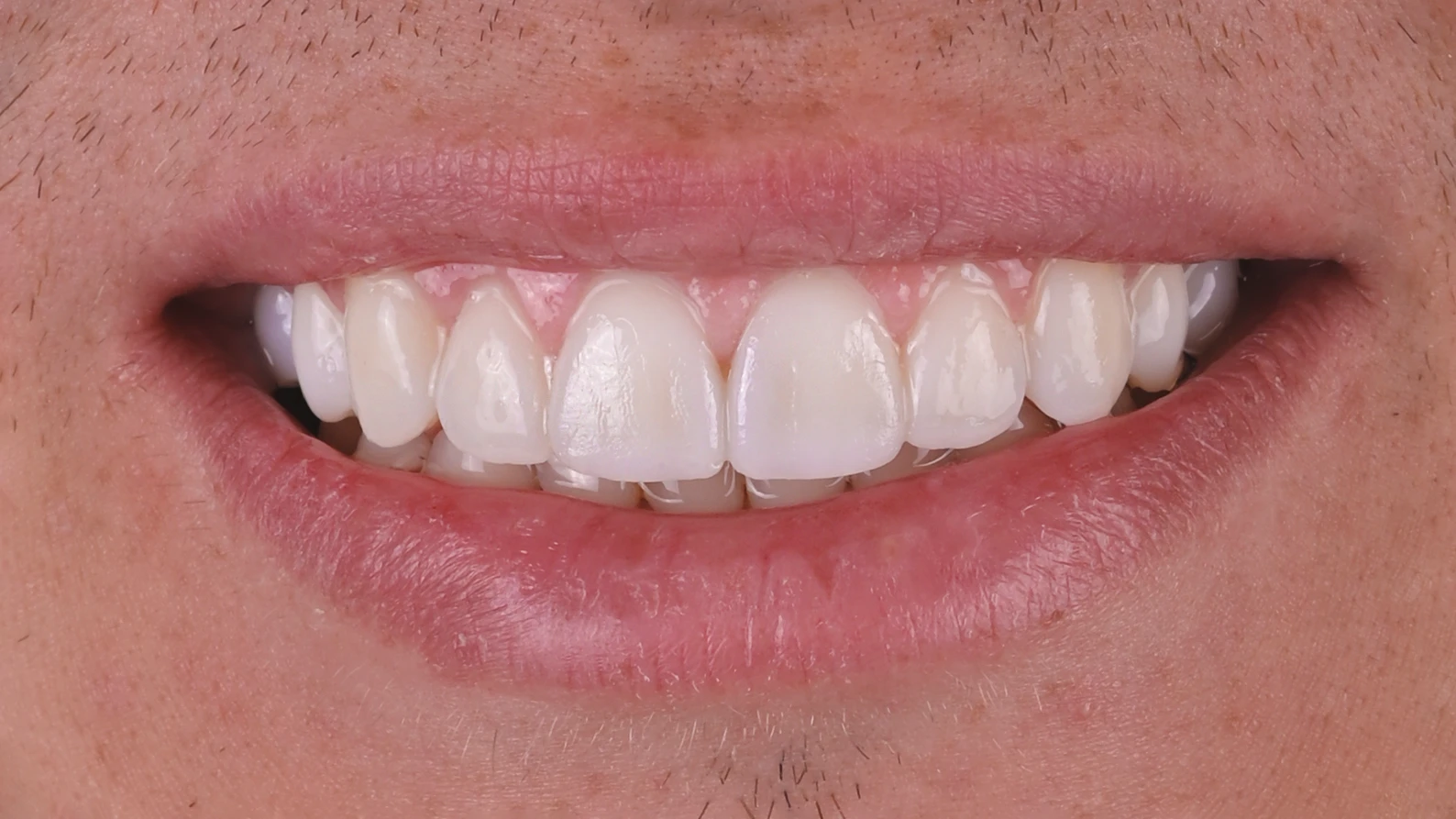 Jak zacząć leczenie stomatologiczne w EndoEstetica Luboń? 2 Po korekcie