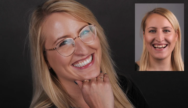 Licówki DSD w Luboniu – naturalny i piękny uśmiech na nowo 9 Anna