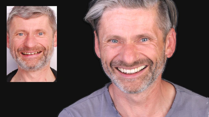 Licówki DSD w Luboniu – naturalny i piękny uśmiech na nowo 8 Remigiusz