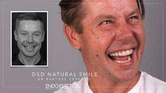 Odzyskaj Piękny Uśmiech z Natural Smile Journey™ w Luboniu 31 endoestetica wlasciciel usmiechu przed i po