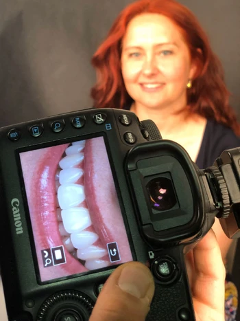 Odzyskaj Piękny Uśmiech z Natural Smile Journey™ w Luboniu 16 Sesja uśmiechu EndoEstetica