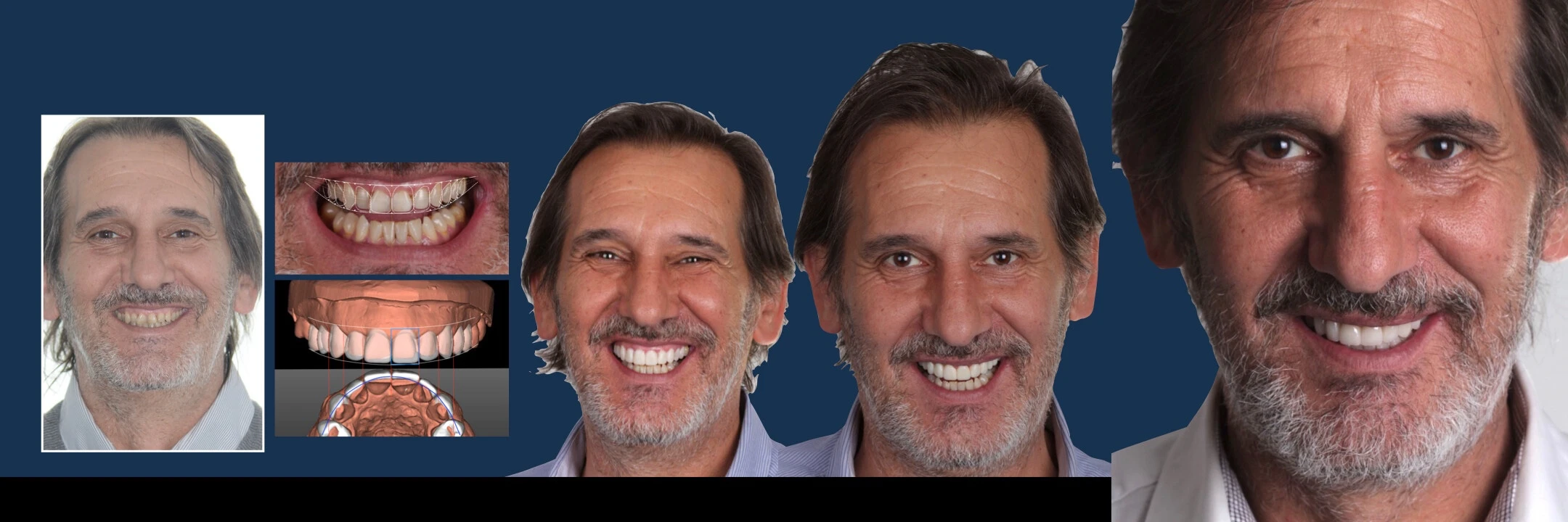 Odzyskaj uśmiech – Protokół Time For Implants™ 15 DSD Natural Restoration