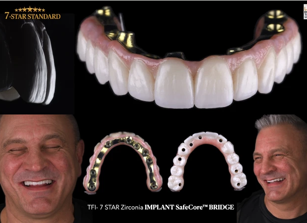 Odzyskaj uśmiech – Protokół Time For Implants™ 5 7 Star Standard