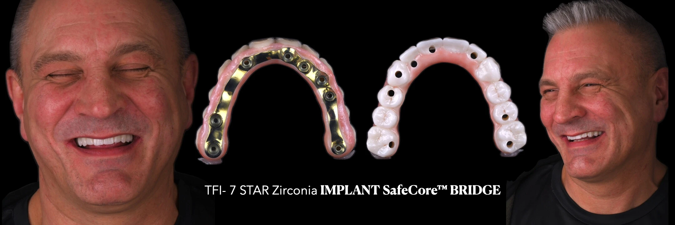 Odzyskaj uśmiech – Protokół Time For Implants™ 16 TFI 7 Star Implant 2