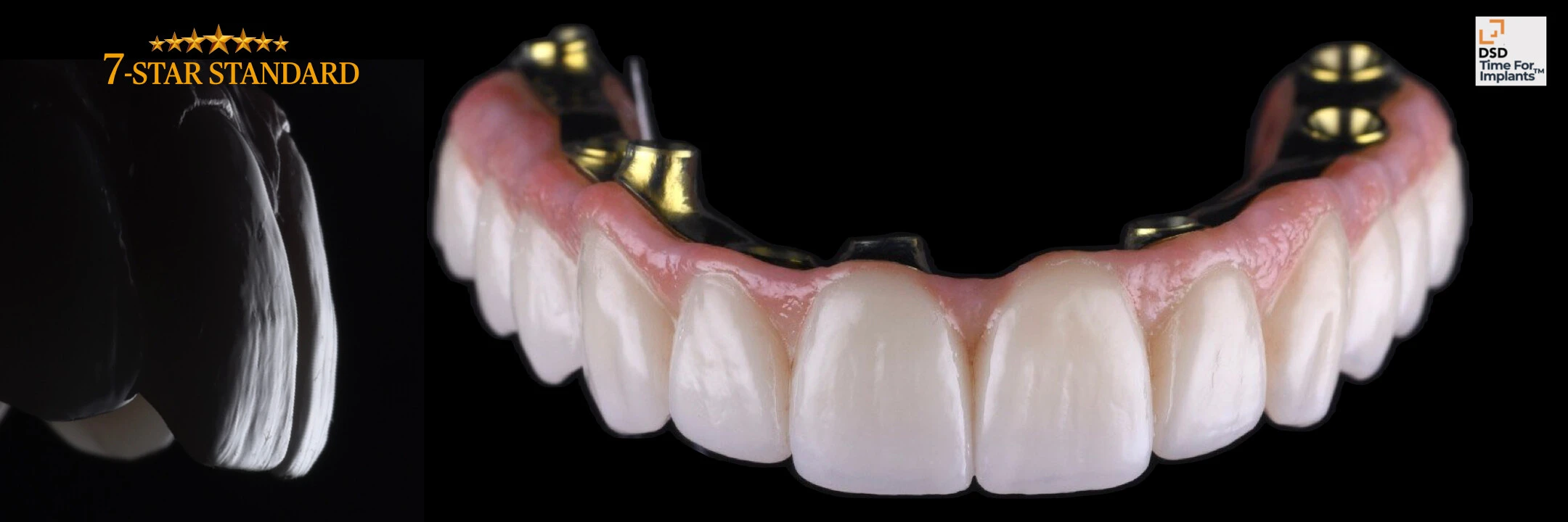 Odzyskaj uśmiech – Protokół Time For Implants™ 14 TFI 7 Star Implant