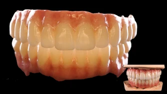 Odzyskaj uśmiech – Protokół Time For Implants™ 8 TFI workflow 1