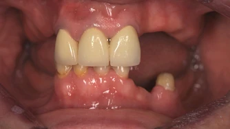 Odzyskaj uśmiech – Protokół Time For Implants™ 9 TFI workflow 2