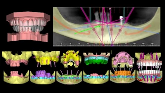 Odzyskaj uśmiech – Protokół Time For Implants™ 10 TFI workflow 3