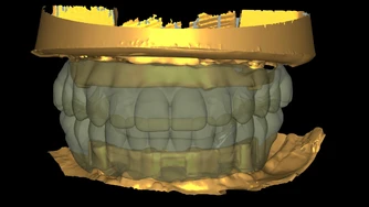 Odzyskaj uśmiech – Protokół Time For Implants™ 11 TFI workflow 4