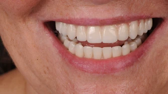 Odzyskaj uśmiech – Protokół Time For Implants™ 12 TFI workflow 5