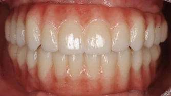 Odzyskaj uśmiech – Protokół Time For Implants™ 13 TFI workflow 6