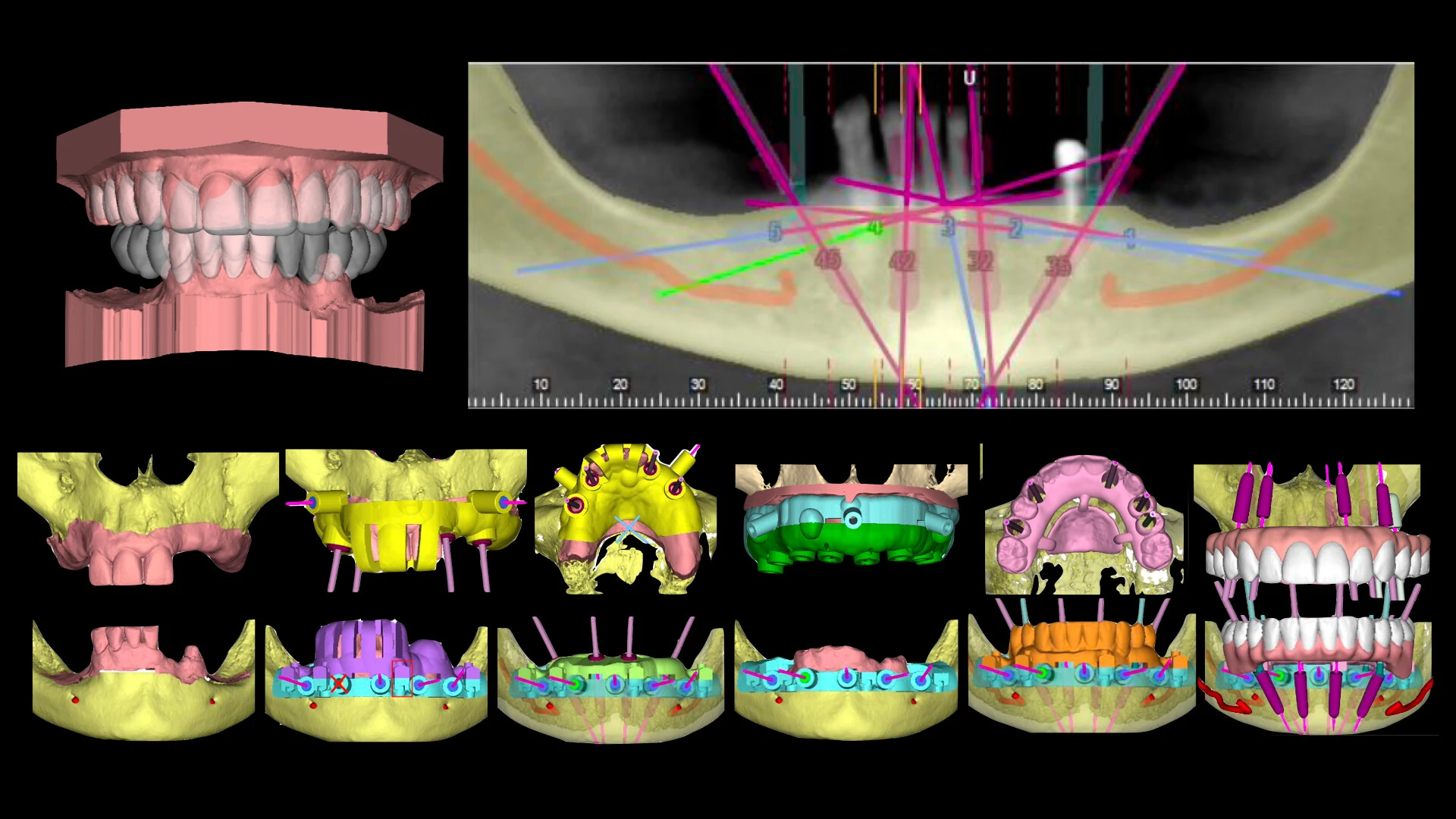 Odzyskaj uśmiech – Protokół Time For Implants™ 17 TFI Workflow