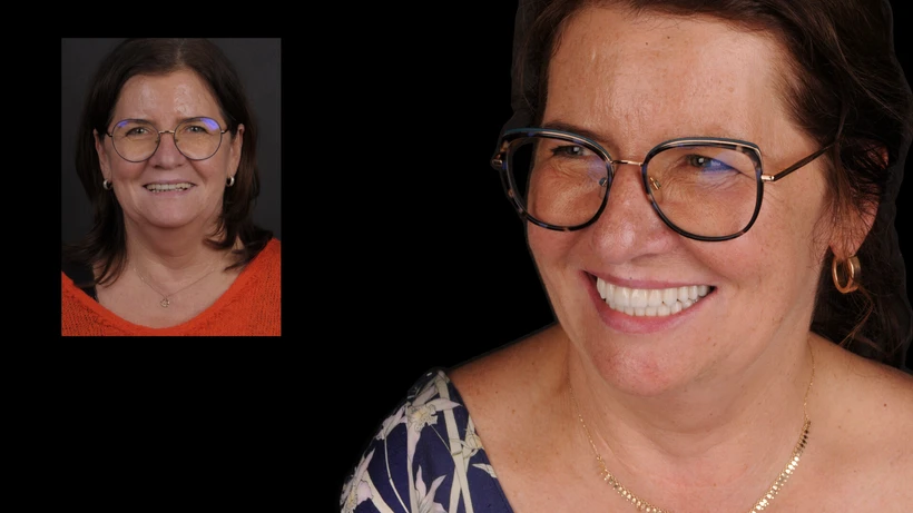 Odzyskaj uśmiech – Protokół Time For Implants™ 7 Małgorzata – Właścicielka Uśmiechu