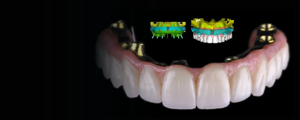 Odzyskaj uśmiech – Protokół Time For Implants™ 3 Implanty EndoEstetica