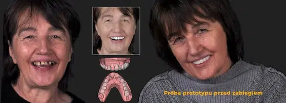 Odzyskaj uśmiech – Protokół Time For Implants™ 22 Krok 1 – prototyp zębów