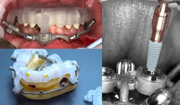 Odzyskaj uśmiech – Protokół Time For Implants™ 25 Krok 2 – implanty nawigacyjne