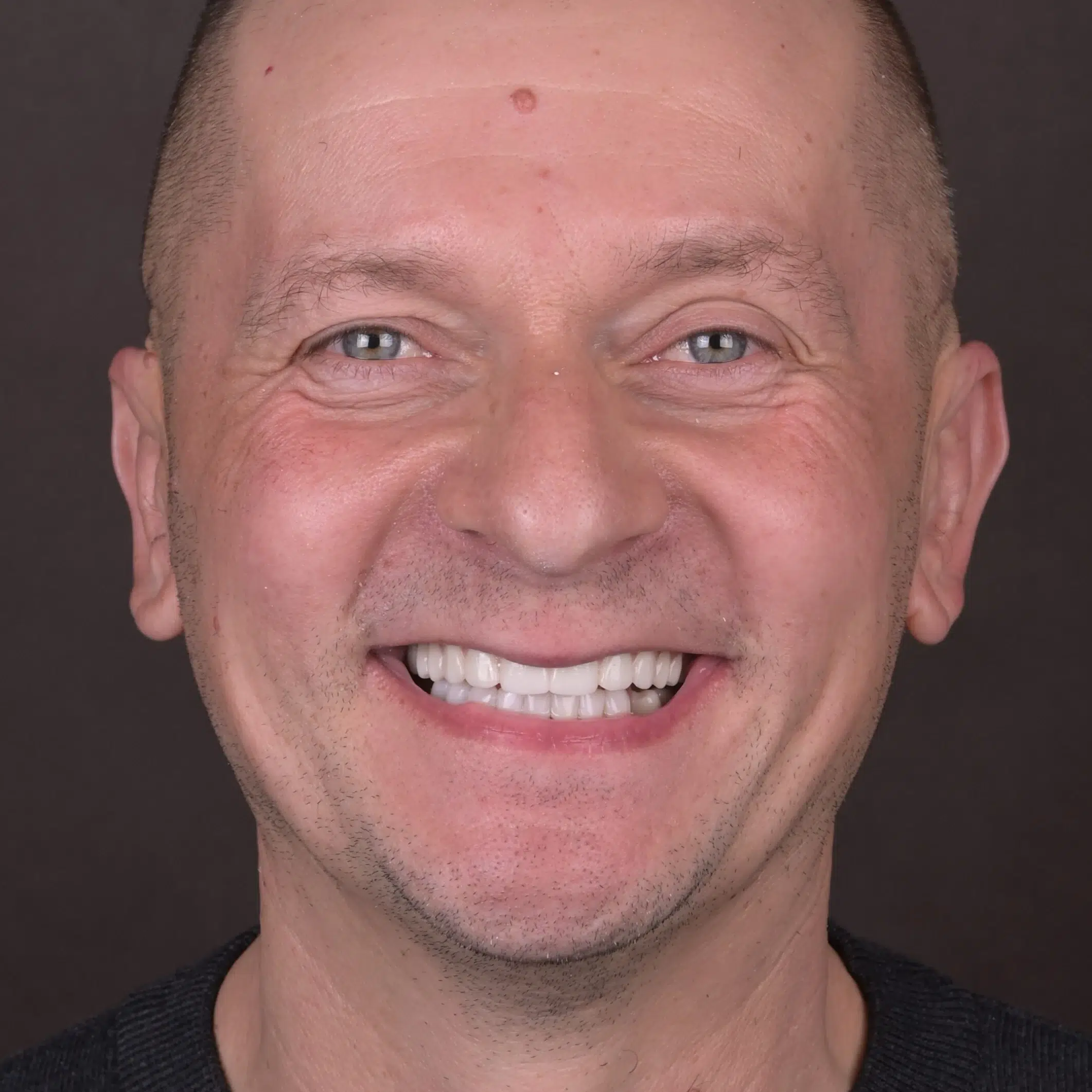 Odzyskaj uśmiech – Protokół Time For Implants™ 40 Efekt 2