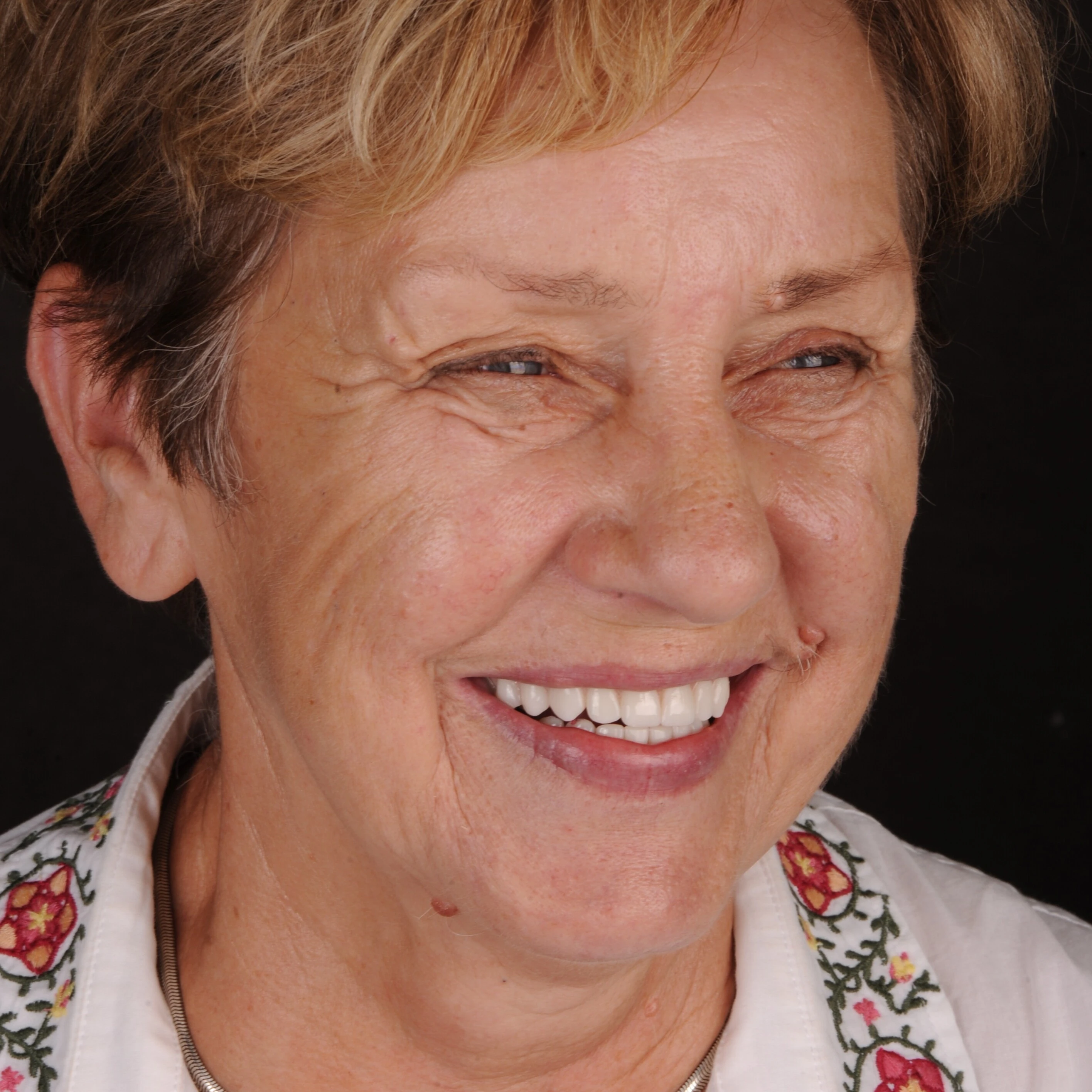 Odzyskaj uśmiech – Protokół Time For Implants™ 43 Efekt 3