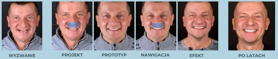 Program rewitalizacji uśmiechu w Luboniu – sprawdź ofertę EndoEstetica 2 Etapy: Wyzwanie – Projekt – Prototyp – Nawigacja – Efekt – Po latach