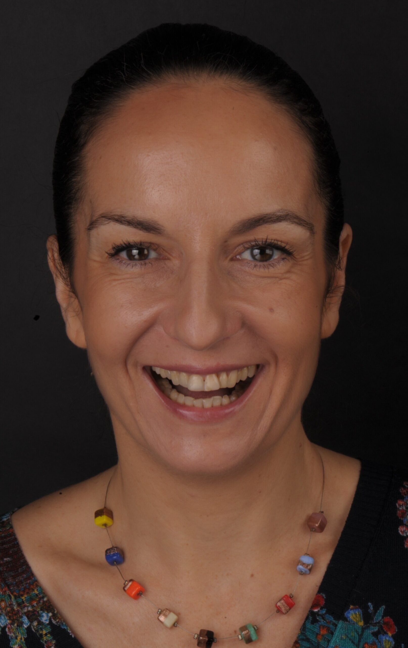 Metamorfoza uśmiechu pani Agaty dzięki DSD Natural Restorations 3 Pani Agata przed terapią