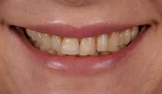 Metamorfoza uśmiechu pani Agaty dzięki DSD Natural Restorations 4 Przed terapią