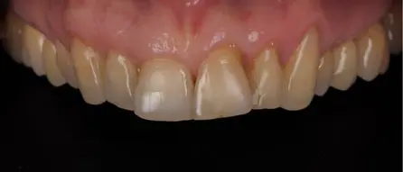 Metamorfoza uśmiechu pani Agaty dzięki DSD Natural Restorations 5 Po terapii