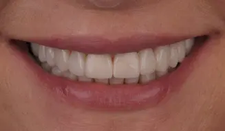 Metamorfoza uśmiechu pani Agaty dzięki DSD Natural Restorations 6 Pacjentka 3