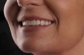 Metamorfoza uśmiechu pani Agaty dzięki DSD Natural Restorations 7 Pacjentka 4