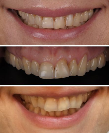 Porównanie uzębienia pani Agaty