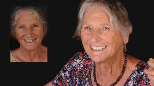 Odzyskaj uśmiech – Protokół Time For Implants™ 18 Krystyna Kałużna