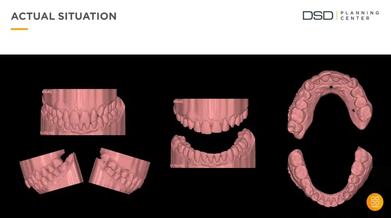 Metamorfoza uśmiechu pani Lucyny dzięki Invisalign i Flow Injection 10 endoestetica pani lucyna aktualna sytuacja przed leczeniem