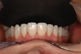 Metamorfoza uśmiechu pani Lucyny dzięki Invisalign i Flow Injection 5 Po terapii