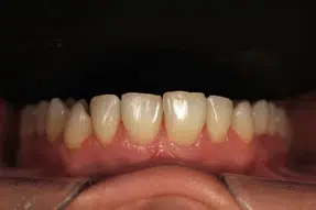 Metamorfoza uśmiechu pani Lucyny dzięki Invisalign i Flow Injection 4 Przed terapią