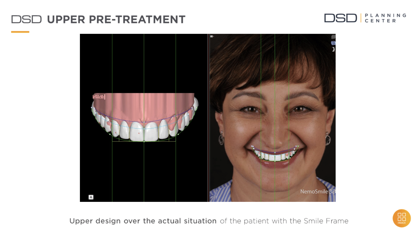 Upper design over the actual situation of the patient with the Smile Frame