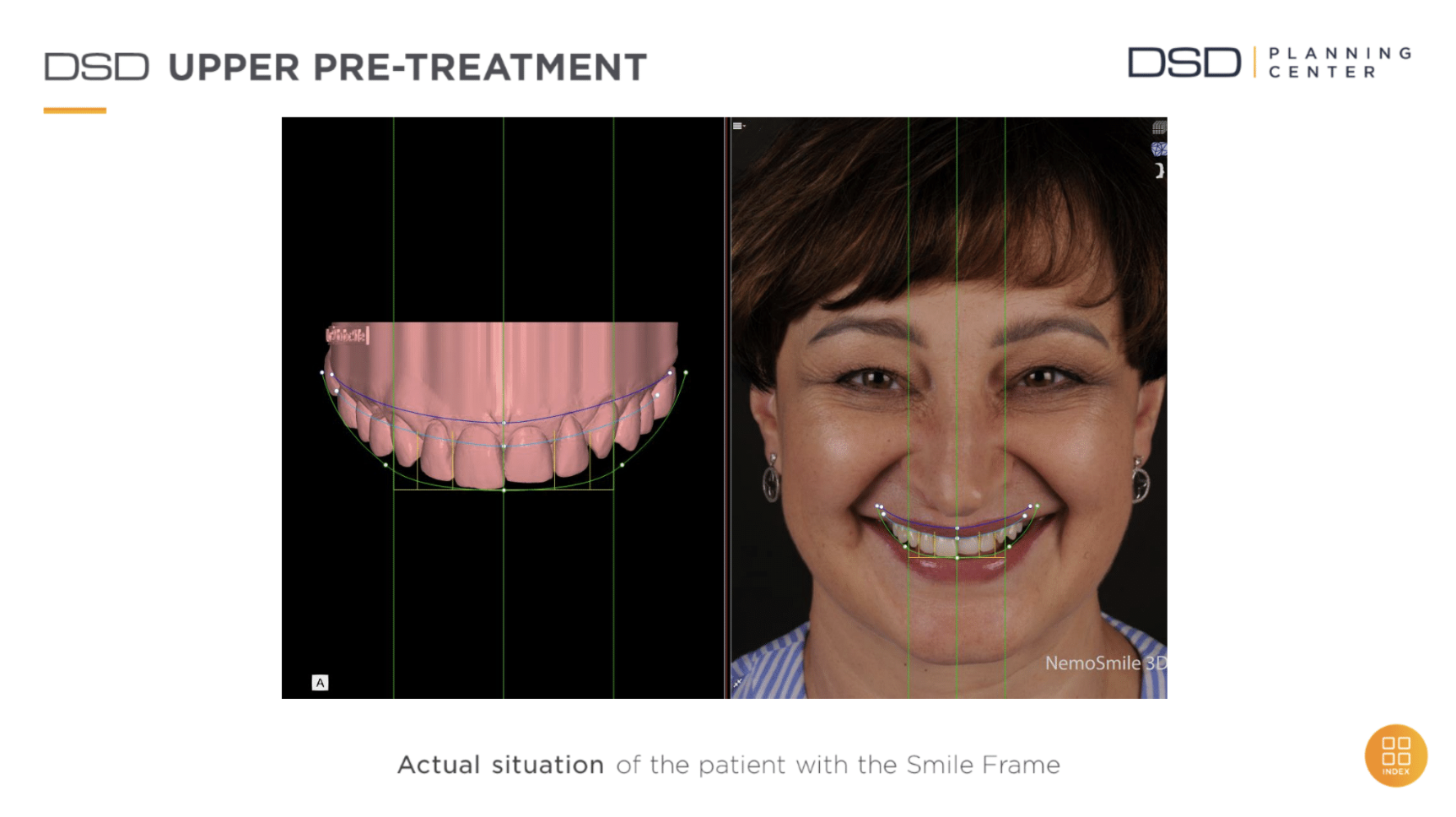 Actual situation of the patient with the Smile Frame
