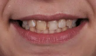 Pani Marta – uśmiech przed leczeniem