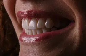 Metamorfoza uśmiechu pani Marty dzięki Invisalign i odbudowie zębów 5 Po terapii