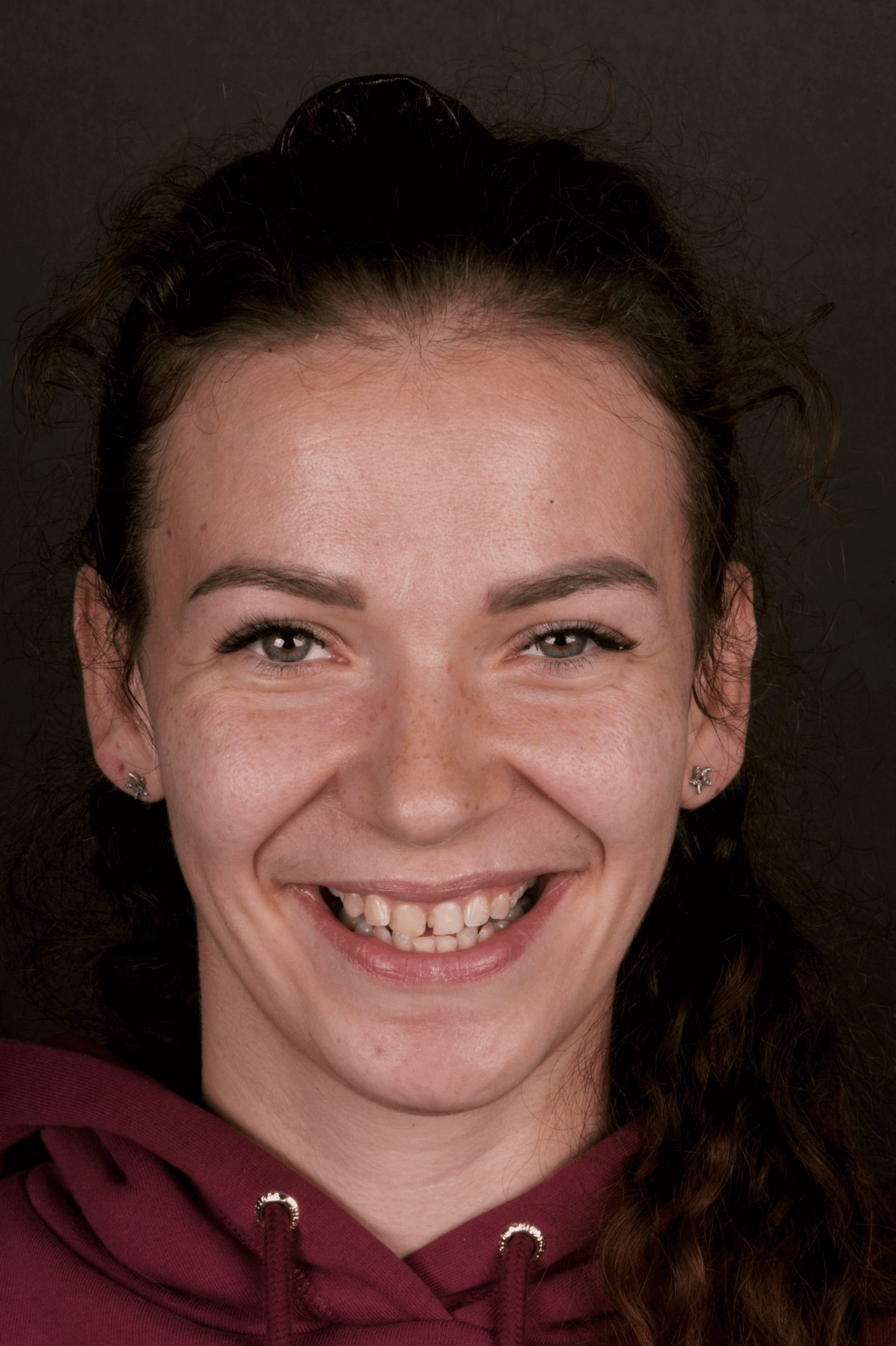 Metamorfoza uśmiechu pani Marty dzięki Invisalign i odbudowie zębów 3 Pani Marta przed terapią