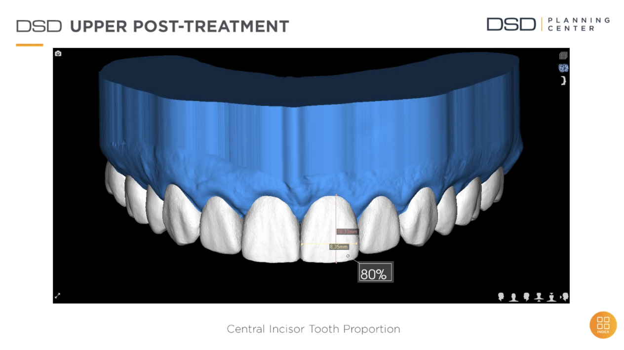 DSD Upper Post-Treatment – Pani Marta