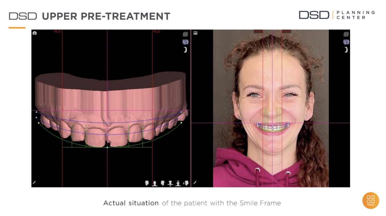 DSD Upper Pre-Treatment – Pani Marta