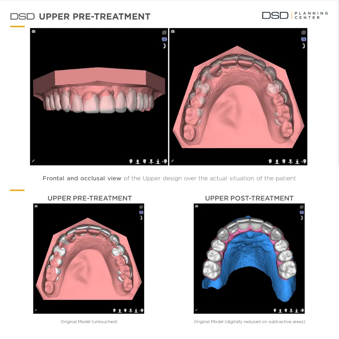 Odzyskaj uśmiech – Protokół Time For Implants™ 36 Planowanie 1