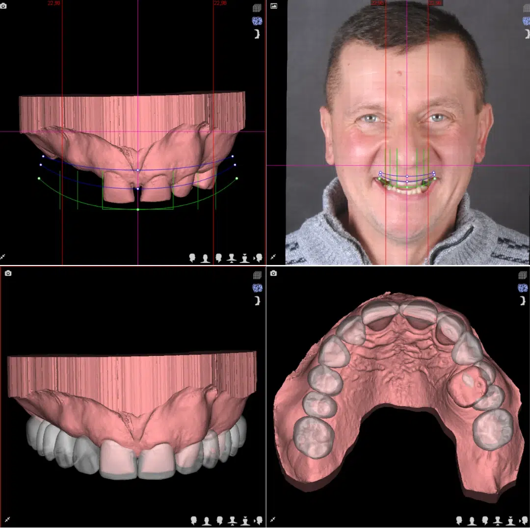 Odzyskaj uśmiech – Protokół Time For Implants™ 39 Planowanie 2