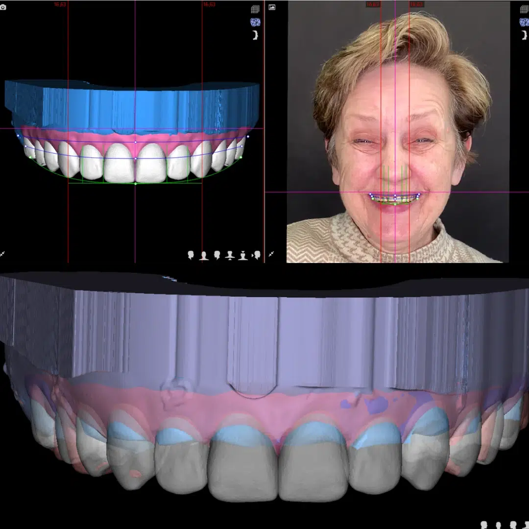 Odzyskaj uśmiech – Protokół Time For Implants™ 42 Planowanie 3