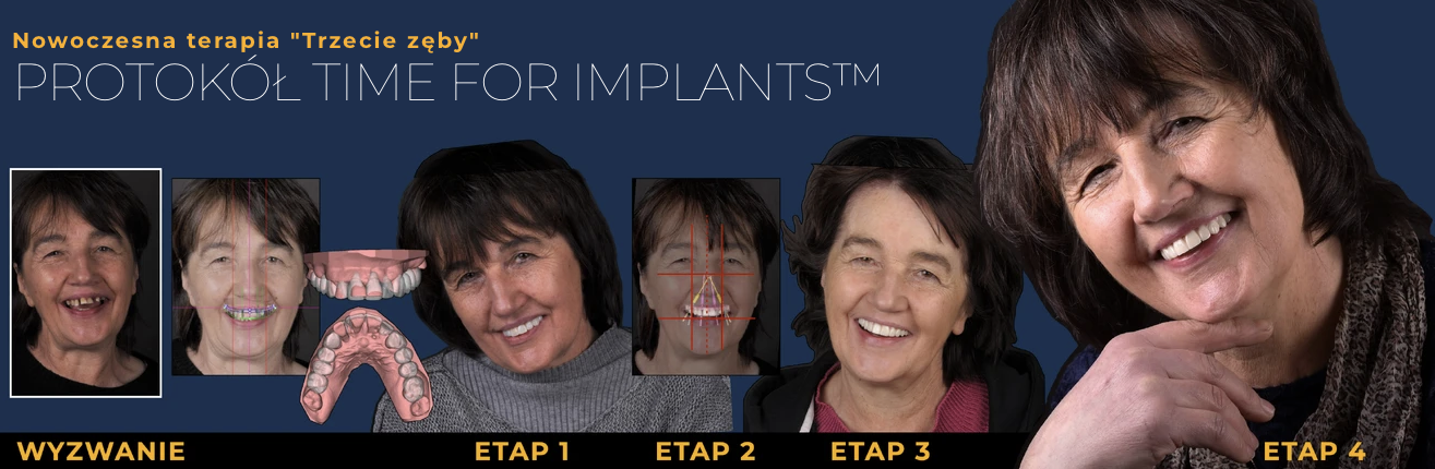 Odzyskaj uśmiech – Protokół Time For Implants™ 33 endoestetica protokol time for implants 1
