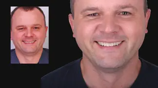 Umów się na spotkanie z Doradcą Terapii w EndoEstetica Clinic 10 dr Marcin Bieńkowski – starcie zębów i bruksizm