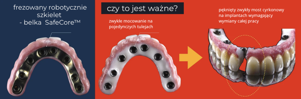 Odzyskaj uśmiech – Protokół Time For Implants™ 20 endoestetica szkielet belka safecore