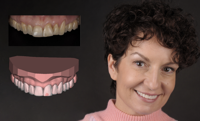 Opinie Pacjentów EndoEstetica Clinic – Metamorfozy Uśmiechu Przed i Po 21 Historia Pani Agaty